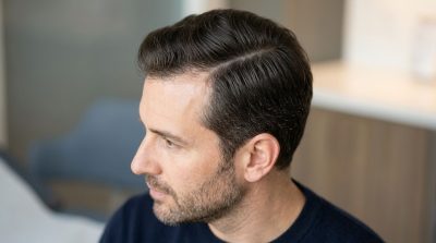 a man's healthy-looking scalp and hair from a natural side angle, subtle thinning at the crown, clean well-groomed appearance
